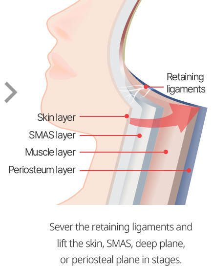 Sever the retaining ligaments and lift the skin, SMAS, deep plane, or periosteal plane in stages.