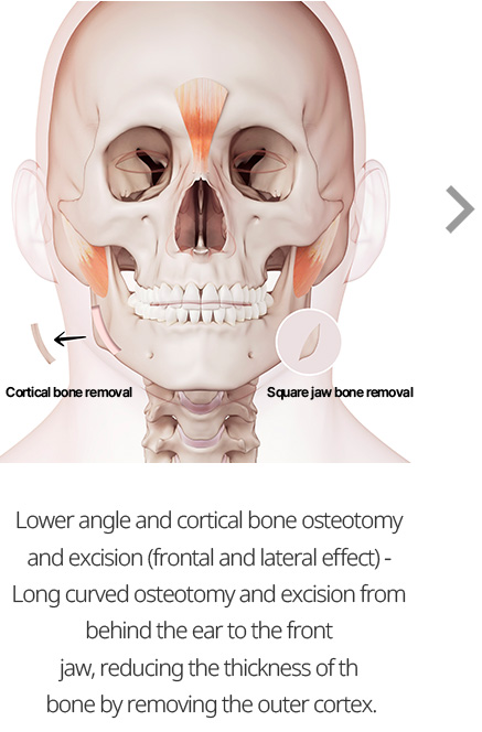 Lower angle and cortical bone osteotomy and excision (frontal and lateral effect) - Long curved osteotomy and excision from behind the ear to the front jaw, reducing the thickness of th  bone by removing the outer cortex.