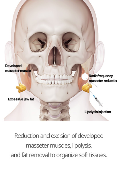 Reduction and excision of developed masseter muscles, lipolysis, and fat removal to organize soft tissues.