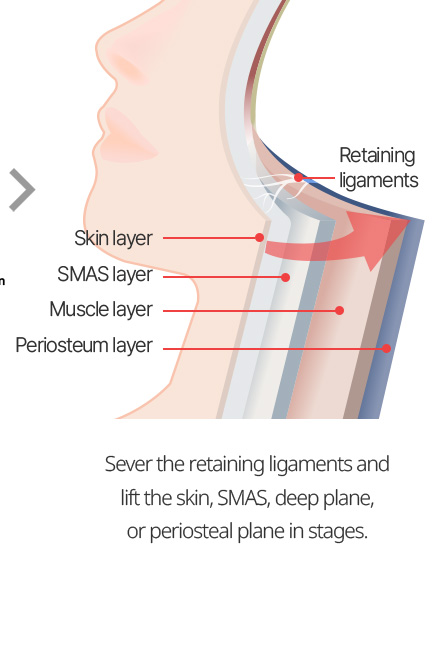 Sever the retaining ligaments and lift the skin, SMAS, deep plane, or periosteal plane in stages.