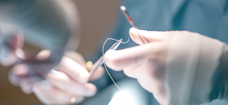 Hidden Scar Technique: Minimal Incision for Minimal Scarring