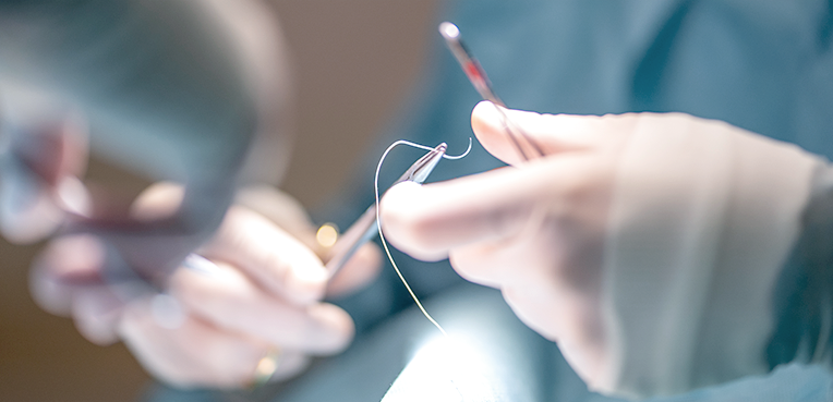 A minimally invasive procedure with a hidden scar, providing discreet and natural-looking results